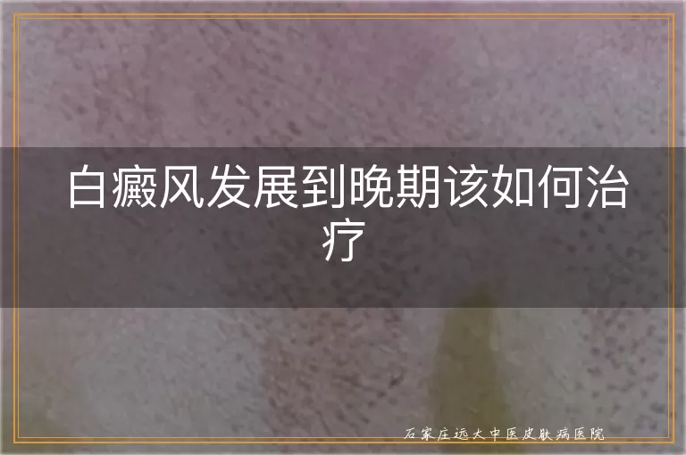 白癜风发展到晚期该如何治疗