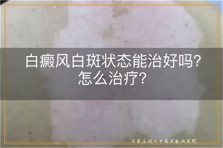 白癜风白斑状态能治好吗？怎么治疗？