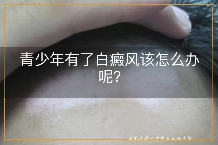 青少年有了白癜风该怎么办呢？