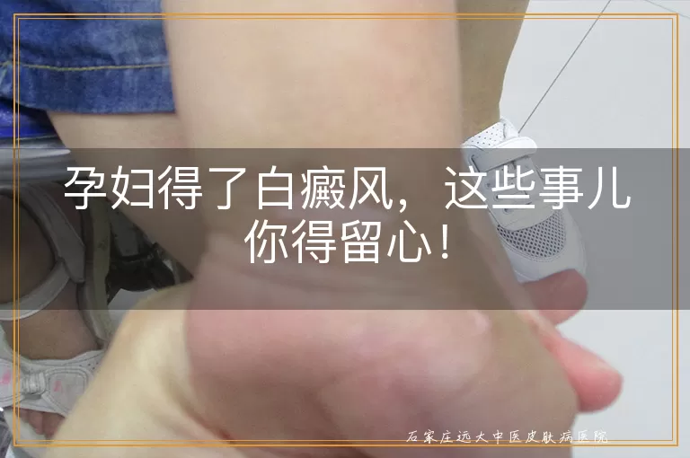 孕妇得了白癜风，这些事儿你得留心！