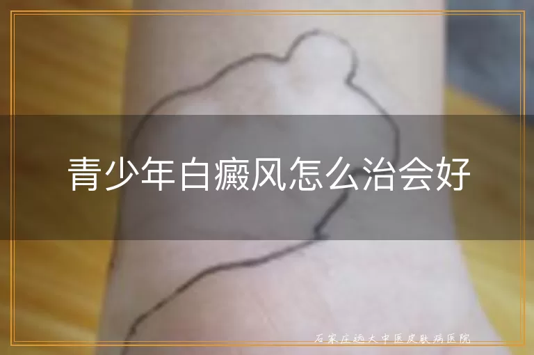 青少年白癜风怎么治会好