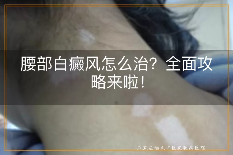 腰部白癜风怎么治？全面攻略来啦！