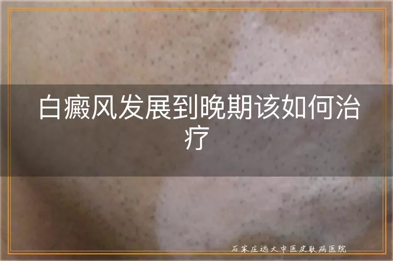 白癜风发展到晚期该如何治疗