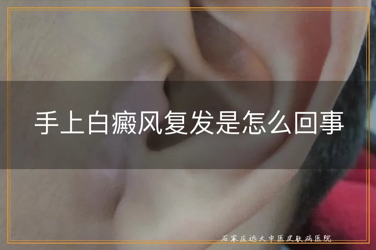 手上白癜风复发是怎么回事