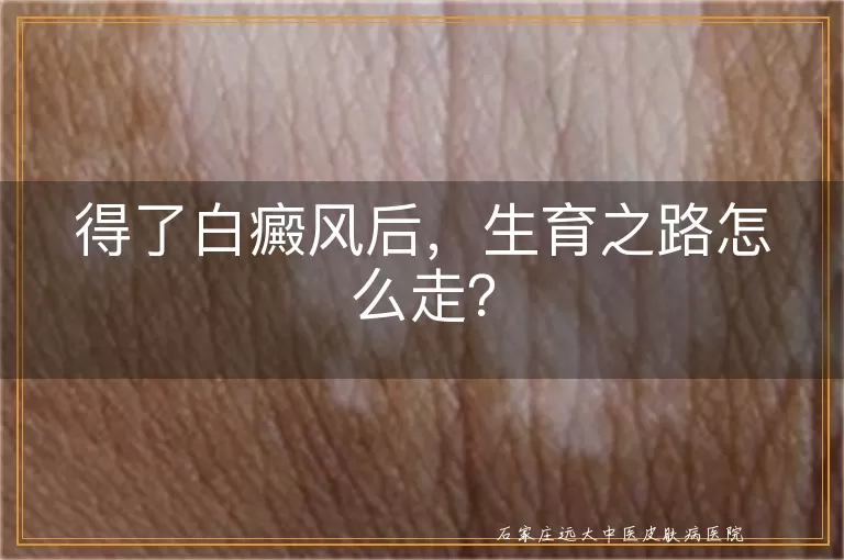 得了白癜风后，生育之路怎么走？