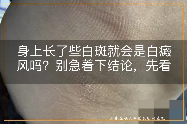 身上长了些白斑就会是白癜风吗？别急着下结论，先看看这些！