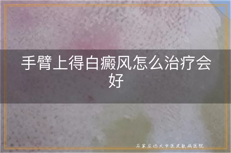 手臂上得白癜风怎么治疗会好