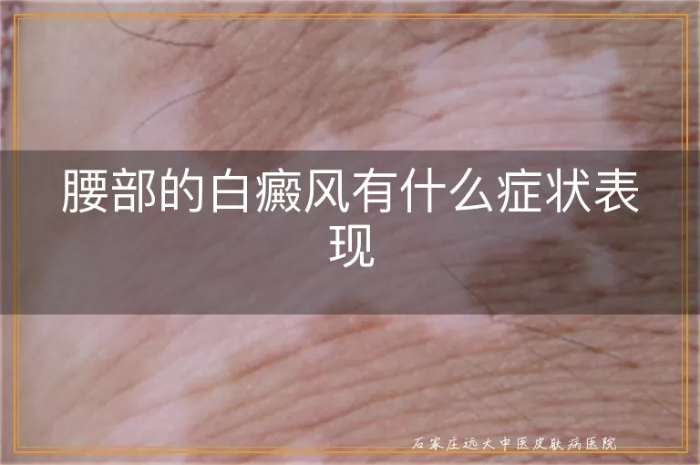 腰部的白癜风有什么症状表现