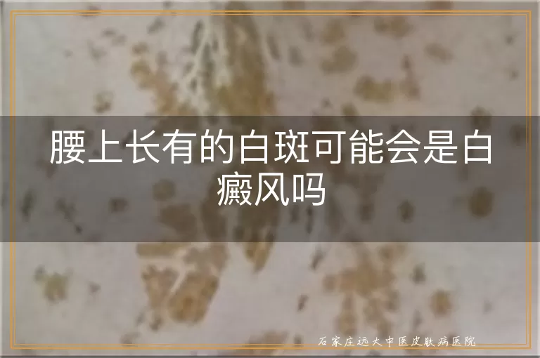 腰上长有的白斑可能会是白癜风吗