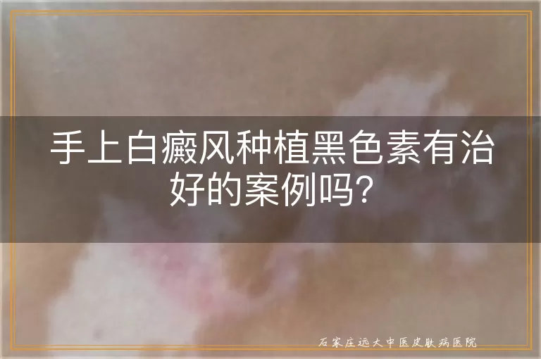 手上白癜风种植黑色素有治好的案例吗？