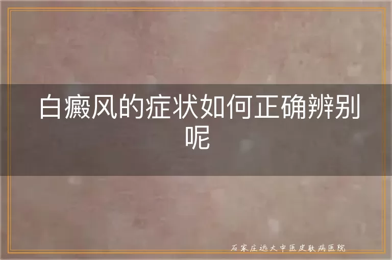 白癜风的症状如何正确辨别呢