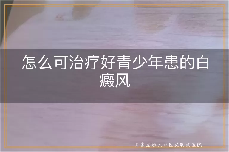 怎么可治疗好青少年患的白癜风