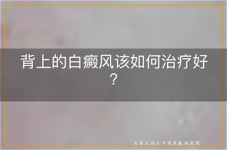 背上的白癜风该如何治疗好？