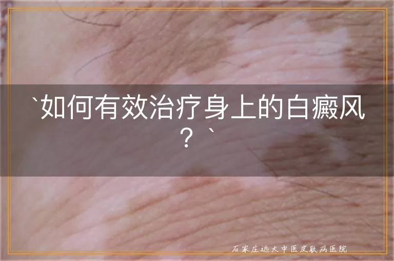 如何有效治疗身上的白癜风？