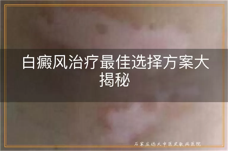 白癜风治疗最佳选择方案大揭秘